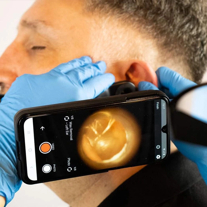 Ear Wax being removed from the ear using microsuction